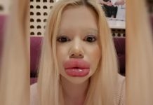 বড় ঠোঁটের রেকর্ড, এবার লক্ষ্য সবচেয়ে বড় গাল তৈরি