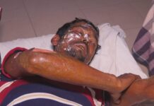 নোয়াখালীতে বিদ্যুতের তার ছিঁড়ে পড়ে বৃদ্ধের মৃত্যু, অগ্নিদগ্ধ ৩